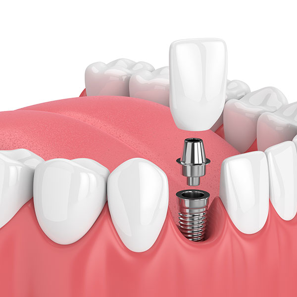 Dental Implants at Dr. Yun Dentist in Grand Rapids MI