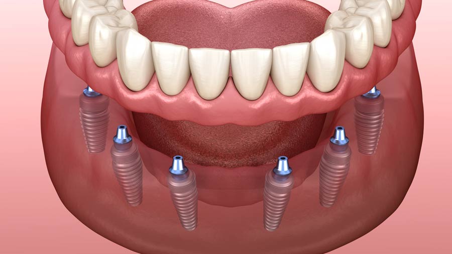 Grand Rapids All-on-6 Implant Dentist