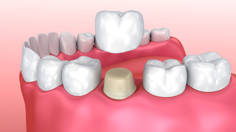 How Are Dental Crowns and Fillings Different? | Dr. Suk Jun Yun