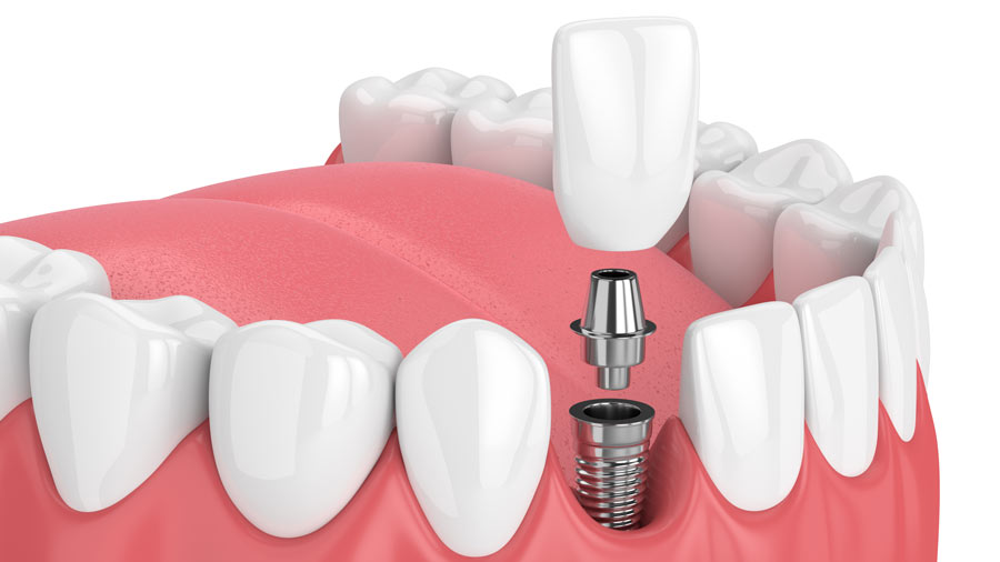 Grand Rapids Dental Implant Dentist