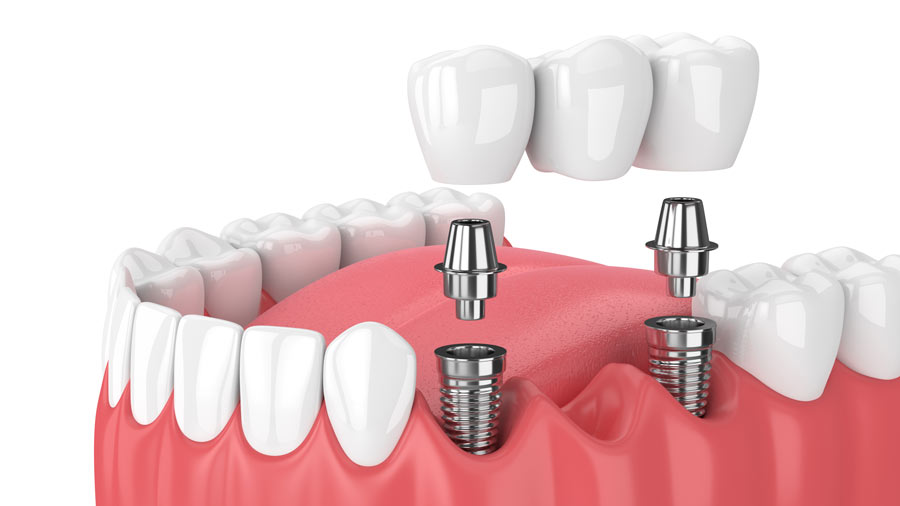 Grand Rapids Implant Supported Bridge Dentist