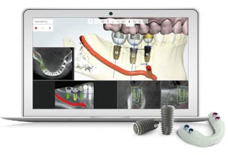 Digital Implant Surgery Grand Rapids, MI