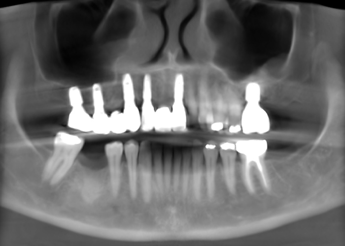 Grand Rapids Dentist Full Mouth Implants