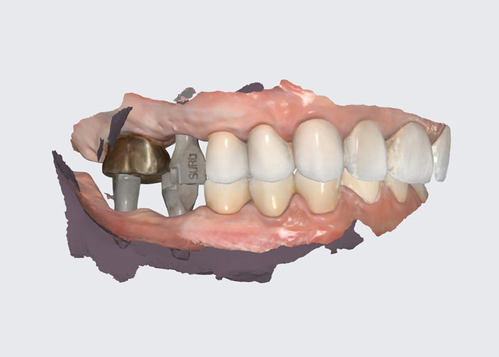 Full Mouth Dental Reconstruction