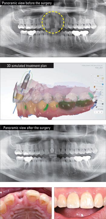 Dental Implants Grand Rapids Dentist