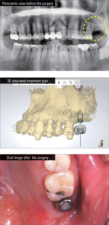 Grand Rapids Dental Implant Dentist