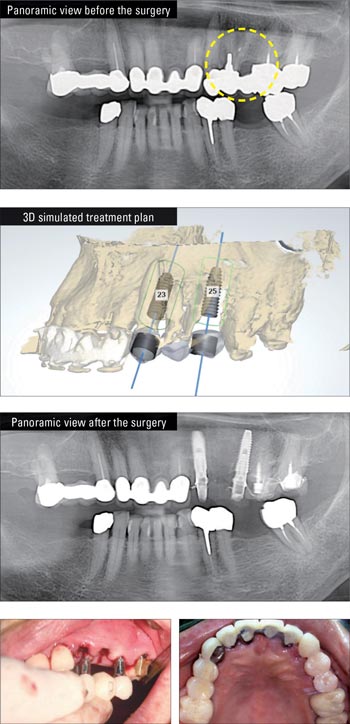 Implant Dentist Grand Rapids, MI