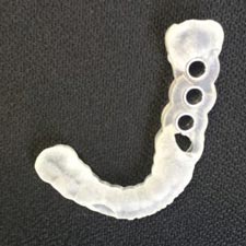 Digital Dental Implant Dentist Grand Rapids, MI