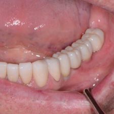 Digital Dental Implants Grand Rapids Dentist