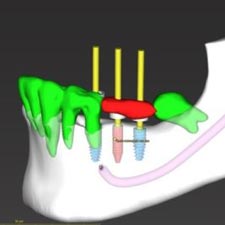 Grand Rapids Dental Implant Dentist