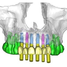 Dental Implant Dentist Grand Rapids, MI